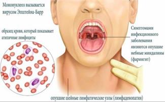 Инфекционный мононуклеоз в детском возрасте: клиника, лечение