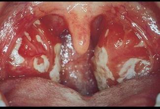 infectious mononucleosis Picture Image on MedicineNet.com