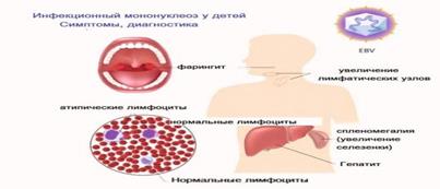 Инфекционный мононуклеоз у детей | ВКонтакте