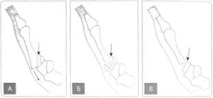 Переломи основи І п'ясткової кістки: А – Беннета; Б – Роландо; В – позасуглобовий