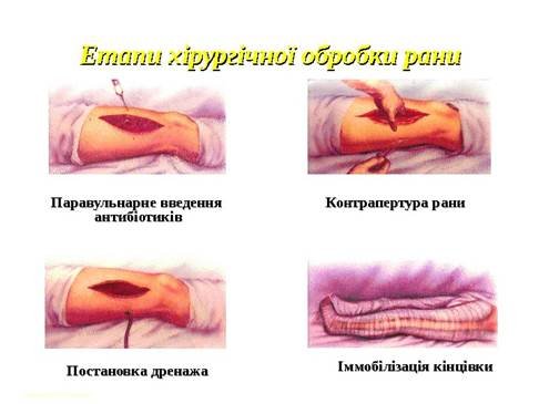 Designed by A. Bondarevskyi Етапи хірургічної обробки рани Паравульнарне введення антибіотиків Контрапертура рани Постановка дренажа Іммобілізація